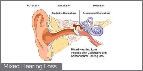 Mixed Hearing Loss - Hearing Aid Specialist - Hearing Clinic in Hyderabad