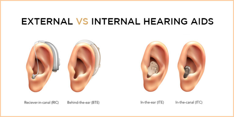 External vs Internal hearing aids